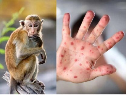 Bệnh đậu mùa khỉ nguy hiểm như thế nào?